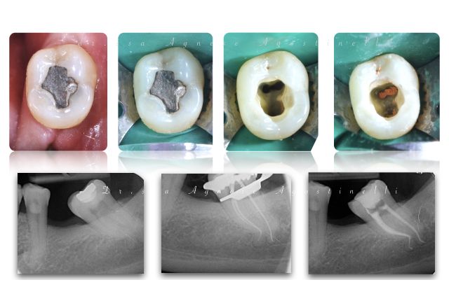 ENDODONZIA DI DENTE CON ANATOMIA COMPLESSA